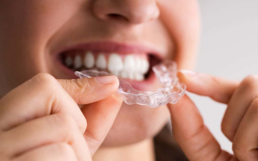 Who Can Benefit from Clear Aligners?