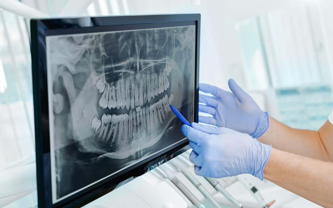 Types of Dental Implants and Their Benefits